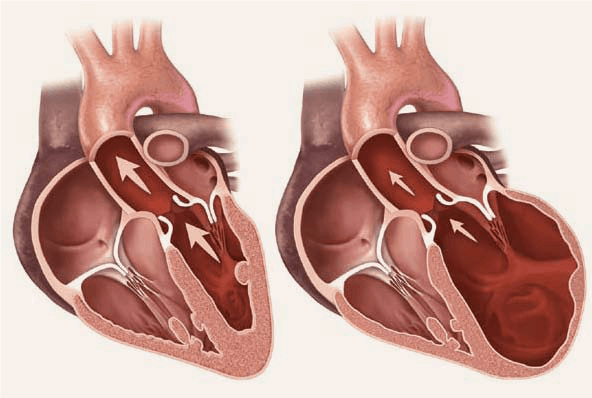Image of a heart in heart failure